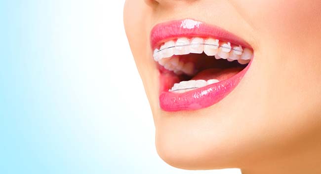 Лечение неправильного прикуса: что следует знать о брекетах? Лечение неправильного прикуса: что следует знать о брекетах?